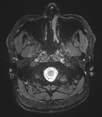 Basal ganglia hemorrhage - hypertensive (Radiopaedia 42227-45303 Axial SWI magnitude 1).png