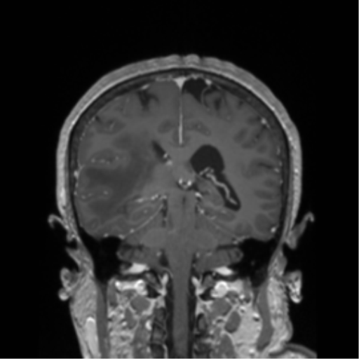 Basal ganglia metastasis (Radiopaedia 78928-91828 Coronal T1 C+ 2).png
