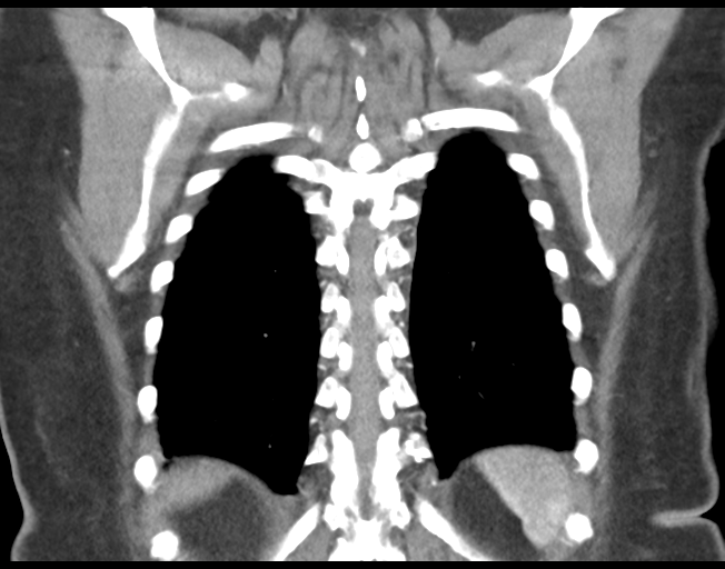 Basal ganglia metastasis (Radiopaedia 78928-91832 C 42).png