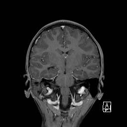 File:Base of skull rhabdomyosarcoma (Radiopaedia 32196-33142 I 41).jpg
