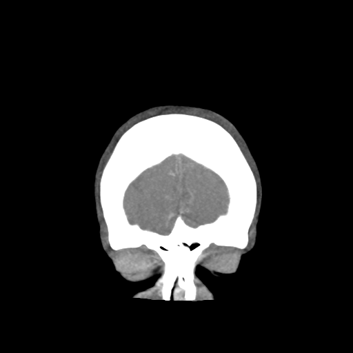 Basilar and bilateral vertebral artery occlusion (Radiopaedia 45592-49723 B 13).png