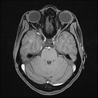 Basilar artery perforator aneurysm (Radiopaedia 82455-97733 Axial T1 fat sat 51).jpg