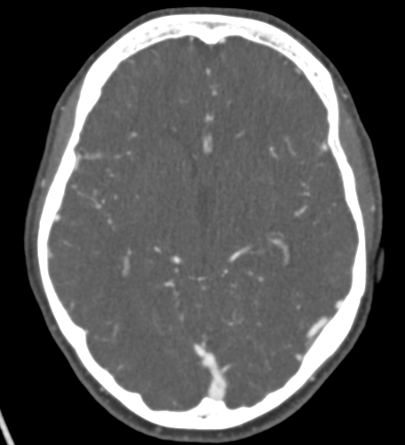 File:Basilar tip aneurysm with coiling (Radiopaedia 53912-60086 A 70).jpg
