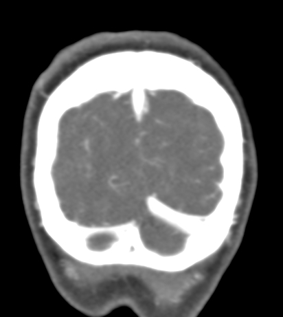 Basilar tip aneurysm with coiling (Radiopaedia 53912-60086 B 148).jpg