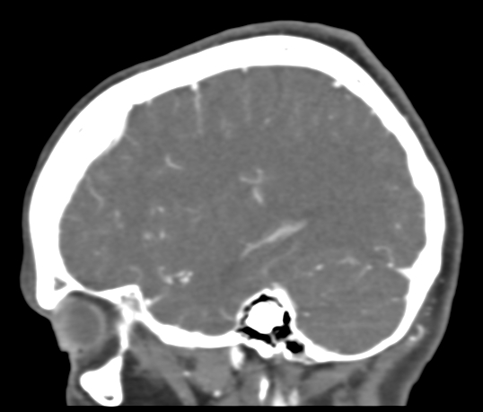 Basilar tip aneurysm with coiling (Radiopaedia 53912-60086 C 101).jpg
