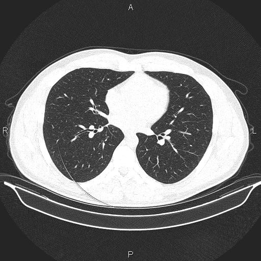 Beam hardening and ring artifacts (Radiopaedia 85323-100915 Axial lung window 44).jpg