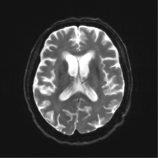 Behavioral variant frontotemporal dementia and late onset schizophrenia (Radiopaedia 52197-58083 Axial DTI Trace W 15).png