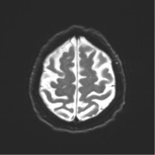 Behavioral variant frontotemporal dementia and late onset schizophrenia (Radiopaedia 52197-58083 Axial DTI Trace W 22).png
