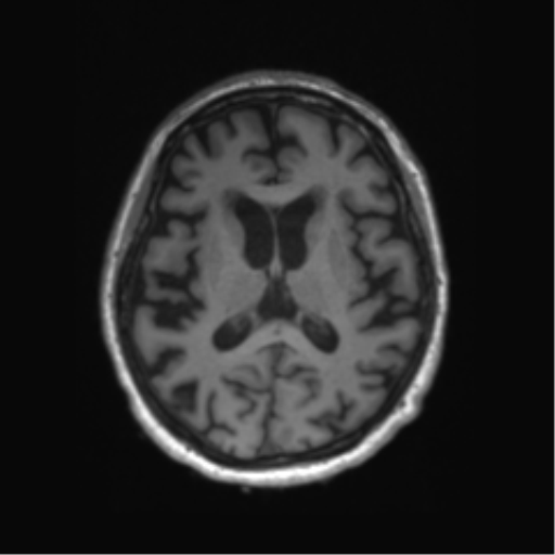 Behavioral variant frontotemporal dementia and late onset schizophrenia (Radiopaedia 52197-58083 Axial T1 43).png