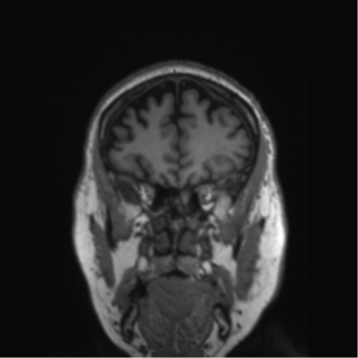 Behavioral variant frontotemporal dementia and late onset schizophrenia (Radiopaedia 52197-58083 Coronal T1 70).png