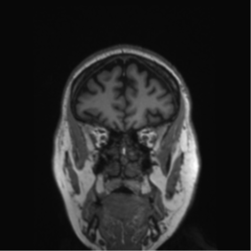 Behavioral variant frontotemporal dementia and late onset schizophrenia (Radiopaedia 52197-58083 Coronal T1 72).png