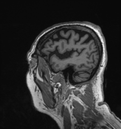 File:Behavioral variant frontotemporal dementia and late onset schizophrenia (Radiopaedia 52197-58083 Sagittal T1 91).png