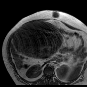 File:Benign seromucinous cystadenoma of the ovary (Radiopaedia 71065-81300 Axial T1 31).jpg