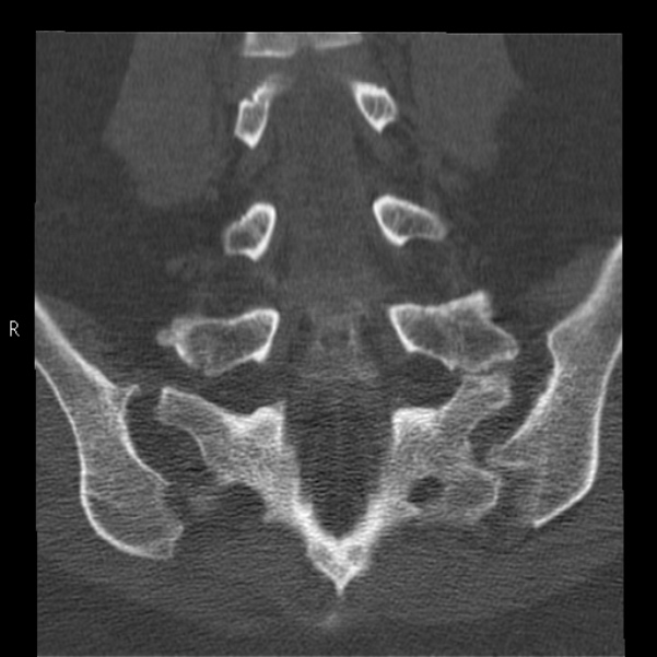 Bertolotti syndrome (Radiopaedia 24864-25128 Coronal bone window 30).jpg