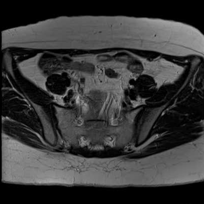 File:Bicornuate uterus (MRI) (Radiopaedia 49206-54297 Axial 33).png