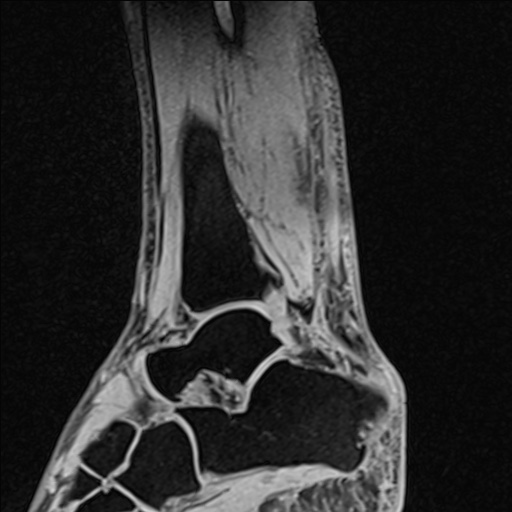 Bilateral Achilles tendon complete tear (Radiopaedia 81344-95051 Sagittal WE - Left 73).jpg