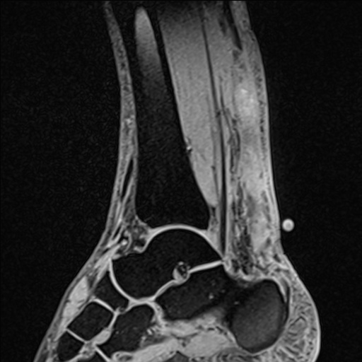 Bilateral Achilles tendon complete tear (Radiopaedia 81344-95051 Sagittal WE - Right 60).jpg