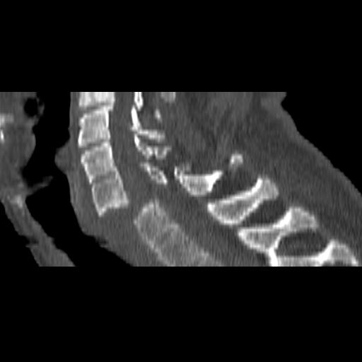 File:Bilateral C6-7 locked facet dislocation (Radiopaedia 28506-28748 Sagittal bone window 11).jpeg