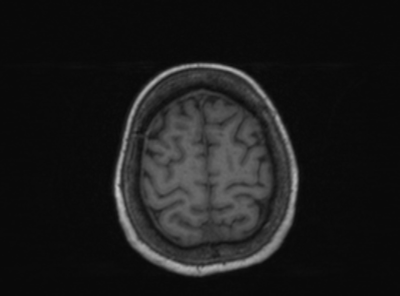 Bilateral PCA territory infarction - different ages (Radiopaedia 46200-51784 Axial T1 147).jpg