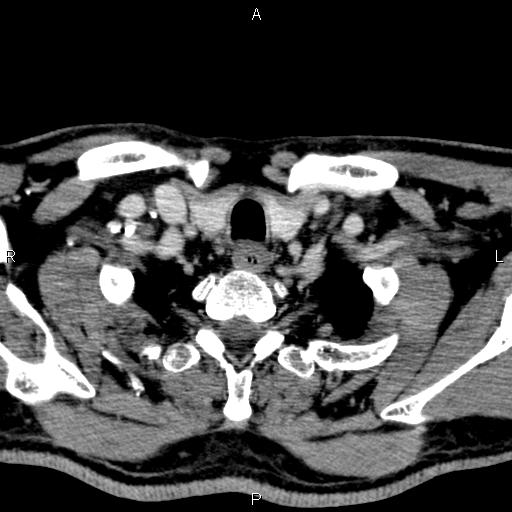 Bilateral Warthin tumors (Radiopaedia 84034-99263 Axial With contrast 61).jpg