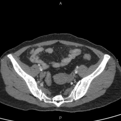 Bilateral adrenal gland hyperenhancement in pancreatitis (Radiopaedia 86642-102753 E 91).jpg