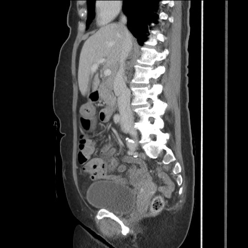 Bilateral adrenal granulocytic sarcomas (chloromas) (Radiopaedia 78375-91007 C 65).jpg