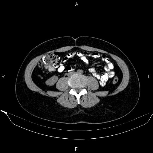 Bilateral adrenal myelolipoma (Radiopaedia 63058-71535 Axial non-contrast 104).jpg