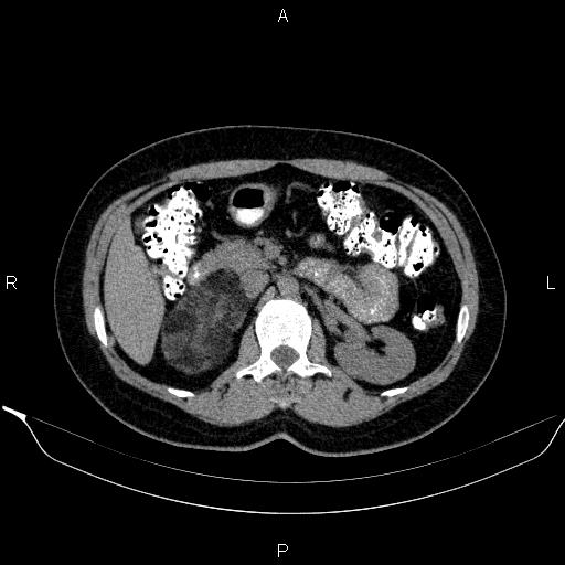 File:Bilateral adrenal myelolipoma (Radiopaedia 63058-71535 Axial non-contrast 65).jpg
