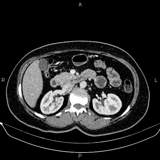 Bilateral benign adrenal adenomas (Radiopaedia 86912-103124 B 43).jpg