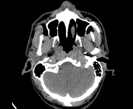 Bilateral carotid body tumors (Radiopaedia 61841-69870 Axial non-contrast 9).jpg