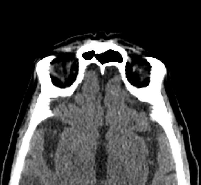 Bilateral ectopia lentis (Radiopaedia 89889-107013 Axial non-contrast 10).jpg