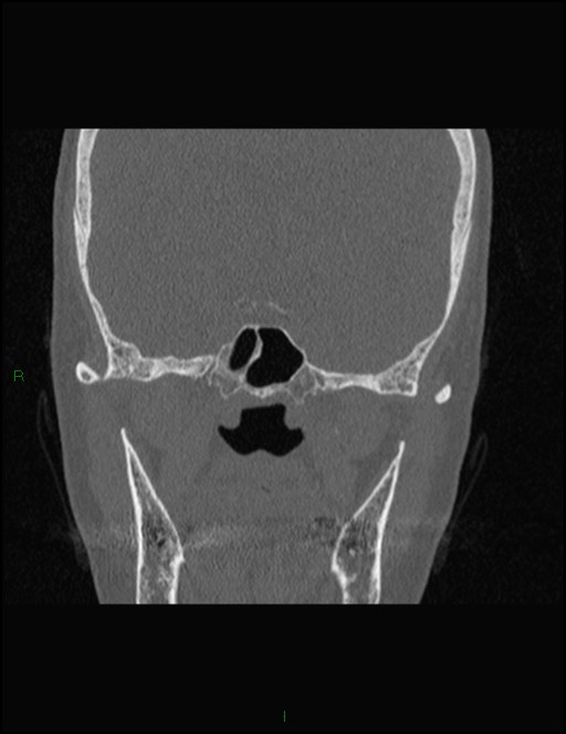 Bilateral frontal mucoceles (Radiopaedia 82352-96454 Coronal 238).jpg
