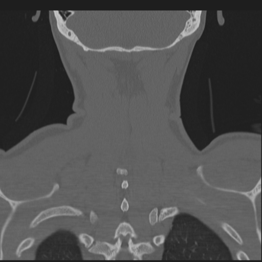 Bilateral locked facets (Radiopaedia 33850-35016 Coronal bone window 75).png
