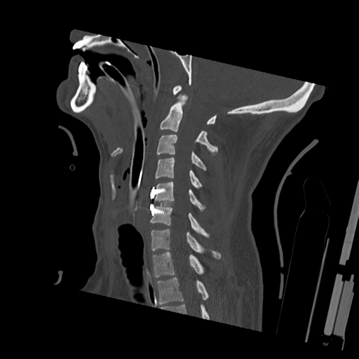 File:Bilateral locked facets (Radiopaedia 33850-35023 Sagittal bone window 29).png