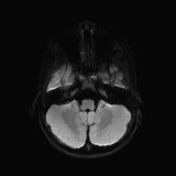 File:Bilateral mesial temporal polymicrogyria (Radiopaedia 76456-88181 Axial DWI 29).jpg