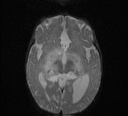 File:Bilateral optic pathway gliomas (Radiopaedia 40013-42514 Axial DWI 8).jpg