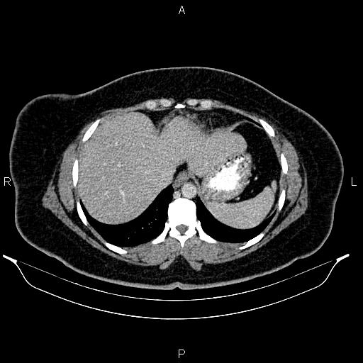 Bilateral ovarian dermoid cysts (Radiopaedia 85785-101603 A 16).jpg