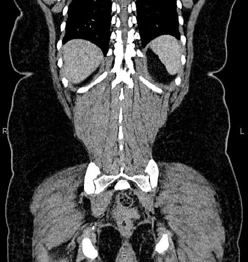 Bilateral ovarian dermoid cysts (Radiopaedia 85785-101603 C 51).jpg