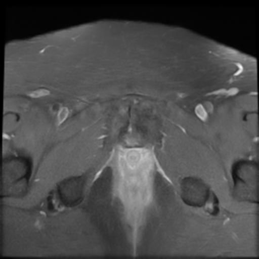 File:Bilateral ovarian dermoid cysts (Radiopaedia 90152-107338 Axial T1 C+ fat sat 21).jpg