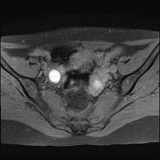 File:Bilateral ovarian endometriomas (Radiopaedia 87085-103347 Axial T1 fat sat 8).jpg