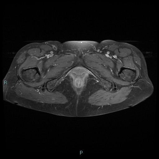 File:Bilateral ovarian fibroma (Radiopaedia 44568-48293 Axial T1 C+ fat sat 29).jpg