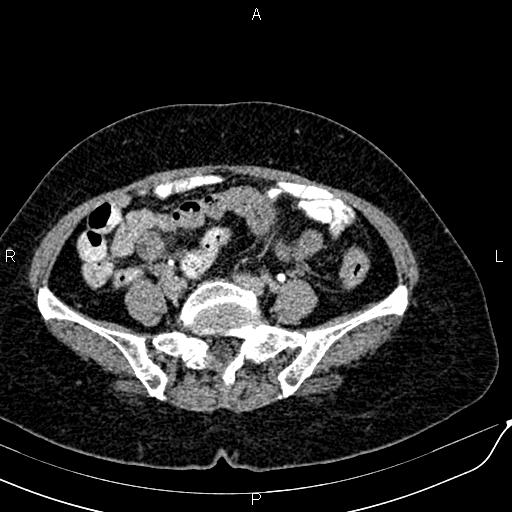Bilateral ovarian serous cystadenocarcinoma (Radiopaedia 86062-101989 Axial C+ delayed 52).jpg