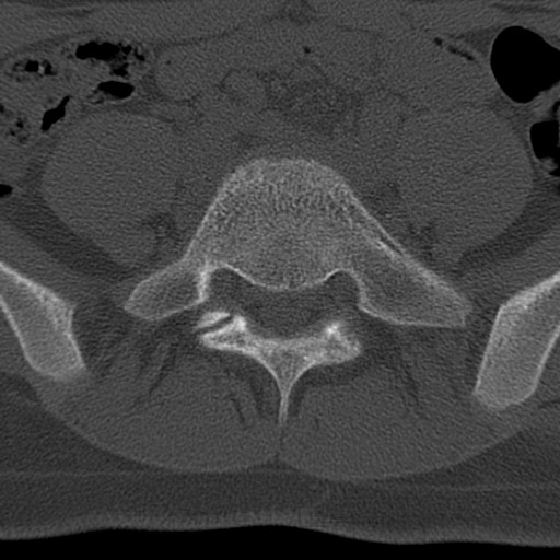 File:Bilateral pars defect (Radiopaedia 26691-26846 Axial bone window 58).jpg