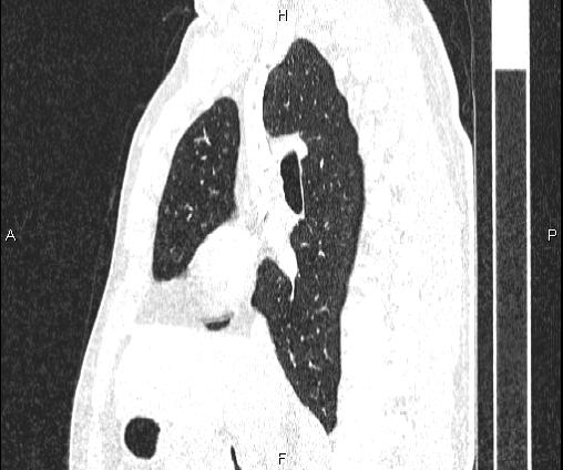 Bilateral pulmonary AVM (Radiopaedia 83134-97505 Sagittal lung window 53).jpg