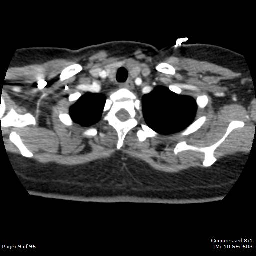 Bilateral pulmonary emboli with Hampton hump sign (Radiopaedia 54070-60246 Axial C+ CTPA 6).jpg