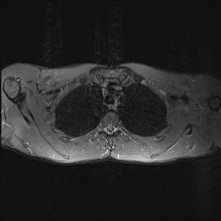 File:Bilateral spinoglenoid notch ganglion cysts (Radiopaedia 29577-30082 Axial STIR 22).jpg