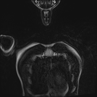 Bilateral spinoglenoid notch ganglion cysts (Radiopaedia 29577-30082 Coronal T2 10).jpg