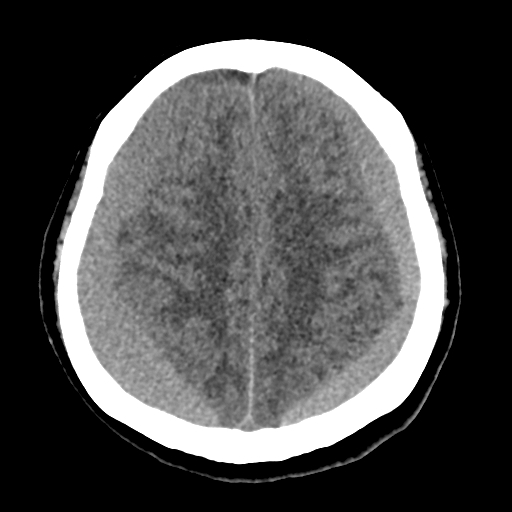 Bilateral subacute subdural hematoma (Radiopaedia 69240-79018 Axial non-contrast 36).jpg