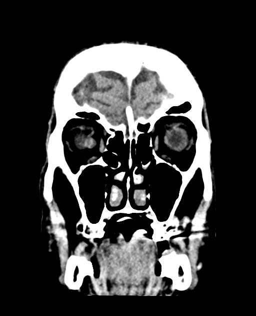 Bilateral subdural hygroma (Radiopaedia 73637-84421 Coronal non-contrast 7).jpg