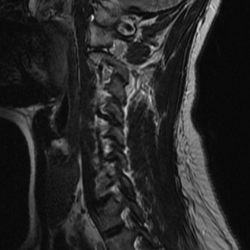 File:Bilateral tortuous vertebral arteries (Radiopaedia 19070-19039 Sagittal T2 8).jpg
